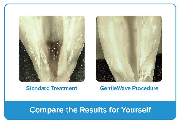 The GentleWave® gives you a cleaner clean and leaves more of your natural tooth structure intact.