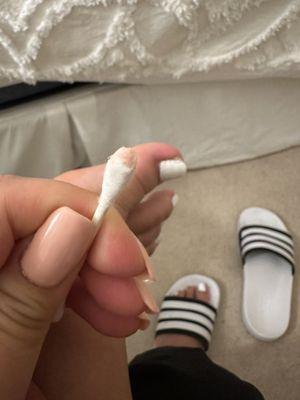 Cut poorly resulting in puss filled ingrown toenail.