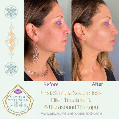 Sculplla Needle-free Filler Treatment