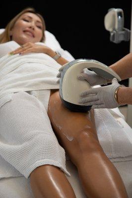 VelaShape III treatment for cellulite improvement