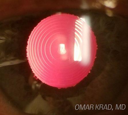 Perfectly centered lens implant