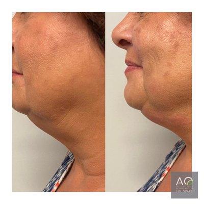 HIFU Treatment on neck