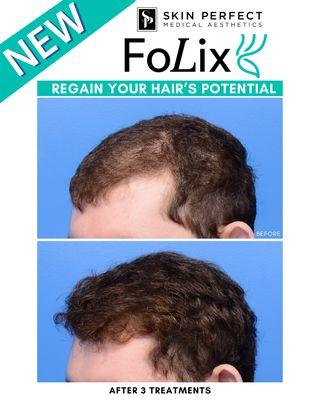 New FoLix Laser for women and men! No downtime, little-to-no pain. 15 minute treatment.