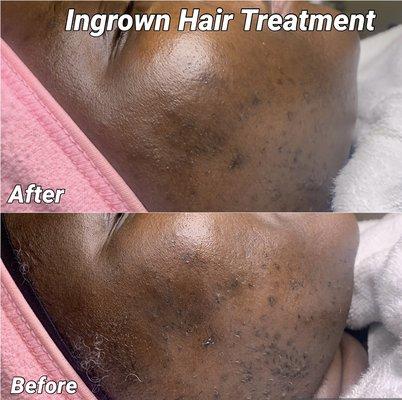 Microdermabrasion and Ingrown hair treatment