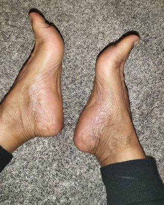 My feet healed from psoriasis