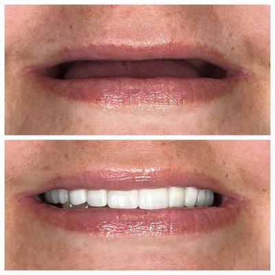 Before/ after 
 Removeable denture to a  full arch fixed implant prosthesis. The second picture is her final zirconia