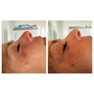 age spot removal