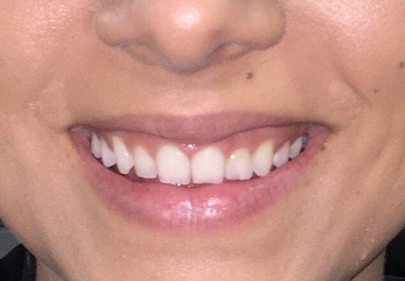 BEFORE....Small teeth, spaces in between, a lot of gum showing