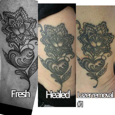 Removery Tattoo Removal & Fading