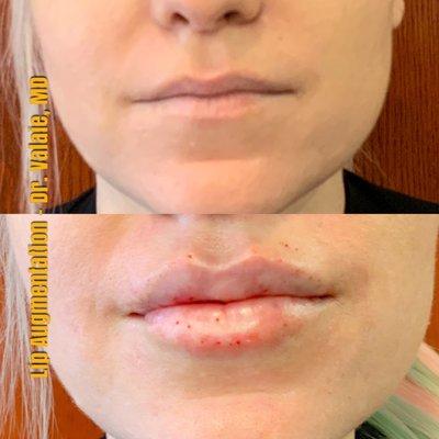 Lip Augmentation - Dr.Valaie, MD