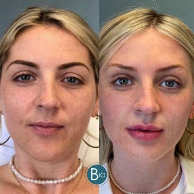 Before & After Botox and Filler