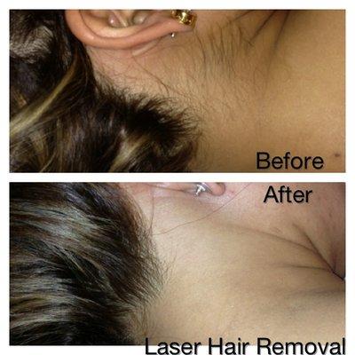 Pain free laser hair removal