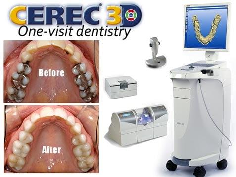 CEREC Single-visit crowns