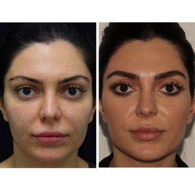 Full Face Rejuvenation