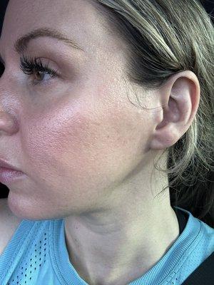 After microneedling. Pits in face, skin is looser, lines/scars where the needle was dragged.