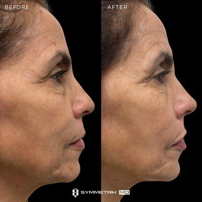 Non-Surgical Nose Job