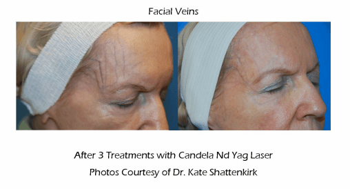 Facial Veins Treatment