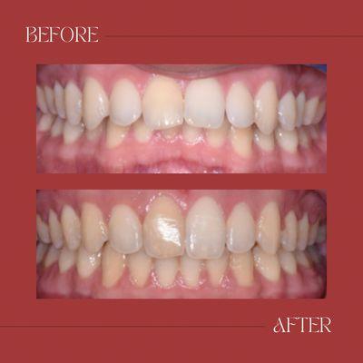 18 month braces case Before & After