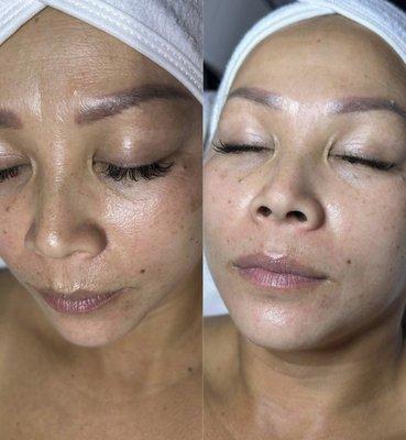 One treatment results from hydra facial and high frequency!