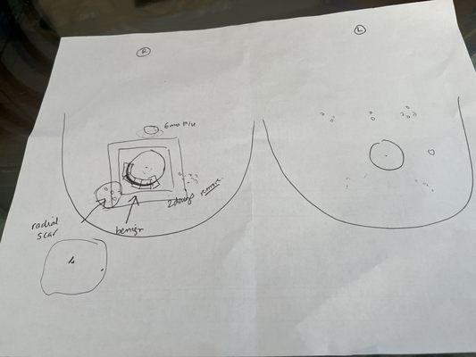 Drawing done by Dr Cindy Cen to explain to surgery process to me. Greatly appreciated.