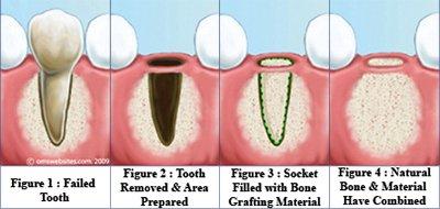 Ext and Adding Bone