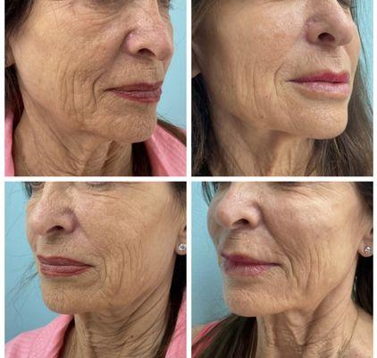 Versa Lip filler and Voluma cheek filler by Michele RN.