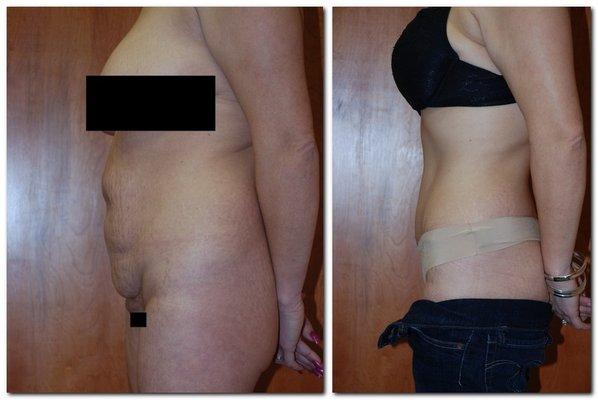 Before and after a tummy tuck