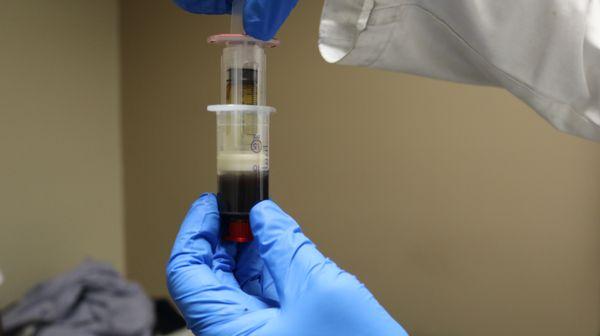 PRP, or platelet rich plasma, is injected into the spine or extremities and has been shown to heal damaged tissue.