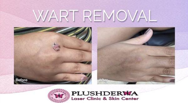 Wart removal