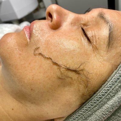 Vellus hair and dead skin build up removed from dermaplaning