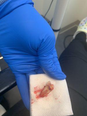 My extracted tooth