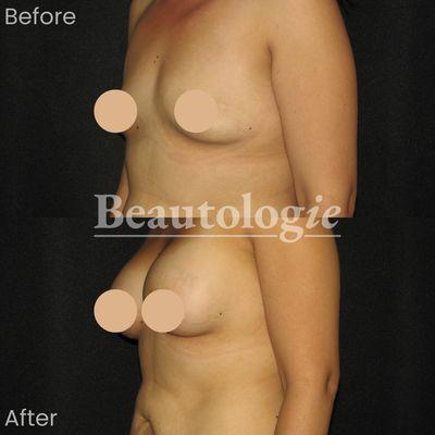 Bilateral Breast Augmentation with 375ml Saline Implants Before and After by Dr. James Knoetgen