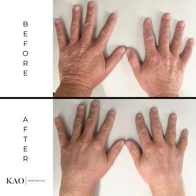 BBL & Moxi Duo - Before and after male hands