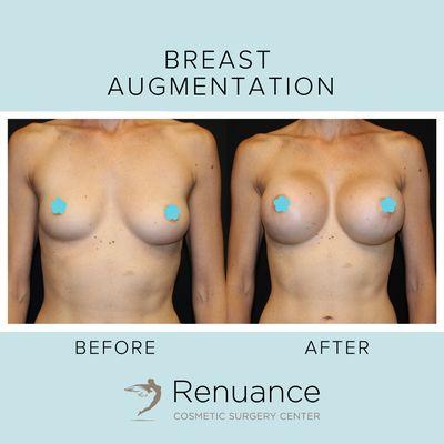 Breast Augmentation at Renuance Cosmetic Surgery Center & Medical Spa in Murrieta, CA