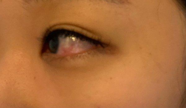 Eye after most recent set