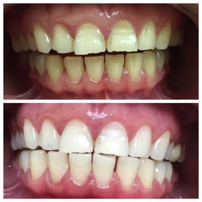 Before and after In office teeth whitening