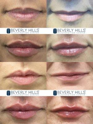 Lip Filler before and after