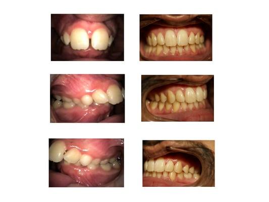 Before and after braces.