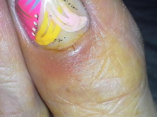 infected toe from K&C nails