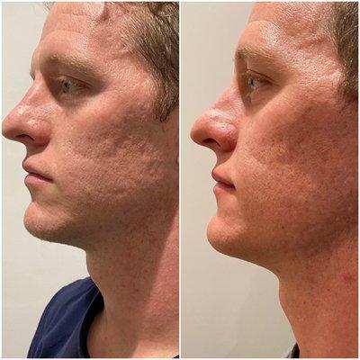 Microneedling for acne scars