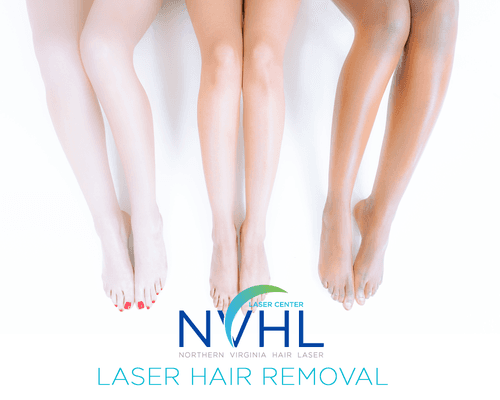 Laser Hair Removal