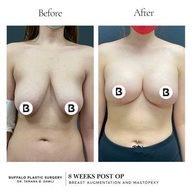 breast aug and mastopexy