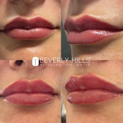 Lip filler!! Lip filler pop only $299