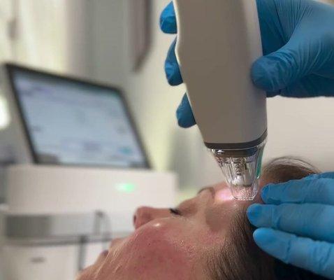 Potenza RF Microneedling