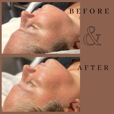 Brightening Dermaplane Facial