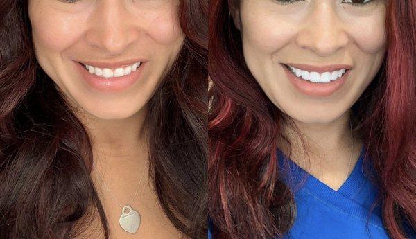 Veneers before and after