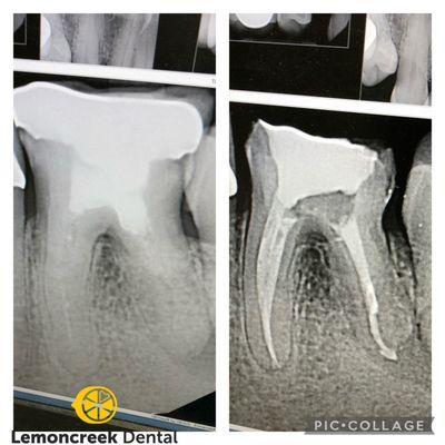 A root canal retreament of a failed root canal with calcification.