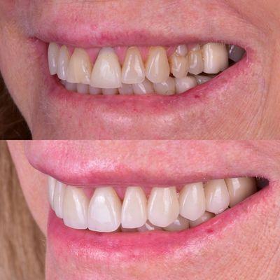 Beautiful and natural smile enhancement for our lovely patient.