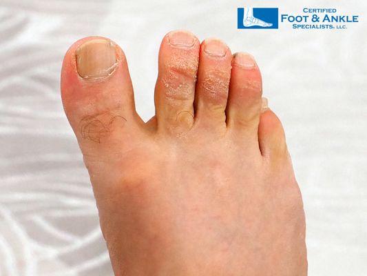 Foot eczema treatment