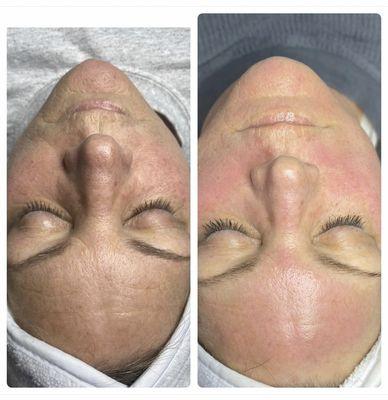 Before & after 2 procell microchanneling treatments. 2 months apart